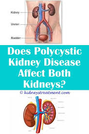 Pin On Kidney Disease Pictures