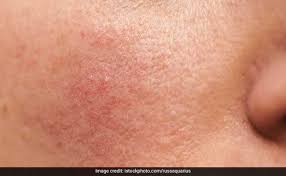 These skin marks are much. Vitamin D Deficiency Signs Of Vitamin D Deficiency Visible On Skin Know Symptoms And Food Sources