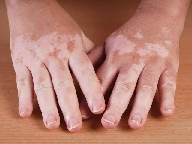 Mga resulta ng larawan para sa Hypopigmentation in Vitiligo"