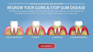 Check spelling or type a new query. Reverse Gum Disease Receding Gums By Eun Stewart Issuu