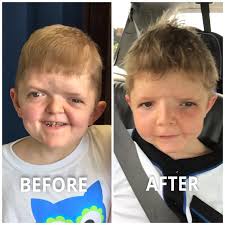 Meet Aiden! 👋 Aiden is a patient ambassador for our upcoming Nemours  Children's Health Run & Walk! Diagnosed with arthrogryposis multiplex  congenita (AMC), Aiden has undergone numerous surgeries and therapies with  the