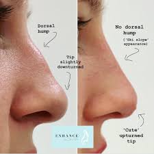 Nose Enhancement To Camouflage The Dorsal Hump Plastic Surgery Costs Dʀ Tᴀʀᴀ S Instagram Profile Nonsurgical Nose Job Nose Fillers Rhinoplasty Nose Jobs