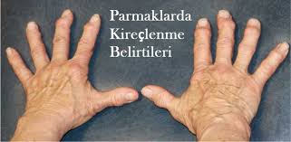 Osteoartrit Kireclenme Ve Tedavi Yontemleri