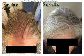 Hair loss is a common side effect of chemotherapy and occurs in about 65 % of patients who receive chemotherapy. Permanent Chemotherapy Induced Alopecia Reversal Follicle Thought