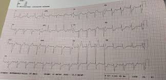 Es una prueba que no te va a doler. Fractura De Cadera Y Sindrome Coronario Dos Emergencias Para Ancianos Nonagenarios En Epoca De Pandemia Covid 19 Ocronos Editorial Cientifico Tecnica