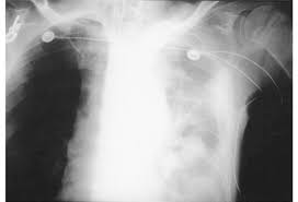 Image result for Hemothorax