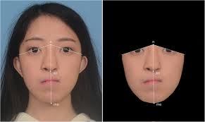 Outcome Of Facial Contour Asymmetry After Conventional Two Dimensional Versus Computer Assisted Three Dimensional Planning In Cleft Orthognathic Surgery Scientific Reports Best two sides quotes selected by thousands of our users! outcome of facial contour asymmetry