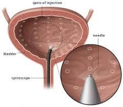 Intravesical Injection Montreal South Shore Laval Quebec Botox Private Urologist Dr Marois London urology provides a comprehensive urology service, offering rapid diagnosis, intervention and aftercare. south shore laval quebec