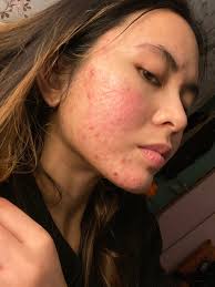 Image result for acne face
