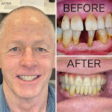 Dental Implants