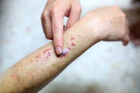 Image result for Vasculitis