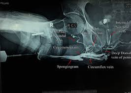 Image result for Retrograde Urethrogram