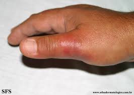 Image result for Erysipeloid