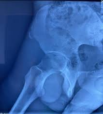 Image result for Hip Apophysitis