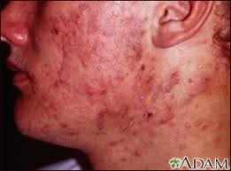 Image result for acne face