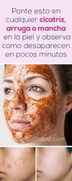 Como Quitar Cicatriz Queloide Arruga O Mancha En La Piel Crema Para Cicatrices Queloide Como Quitar Cicatrices Quitar Cicatrices De Acne Manchas En La Piel