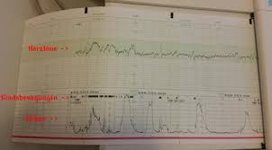 Also das waren auch schon wehen, aber soweit ich weiß, hängt es auch von der einstellung ab die der fa am gerät vornimmt und wie straff der gurt am bauch ist. Tipps Und Tricks Bei Vorzeitigen Wehen