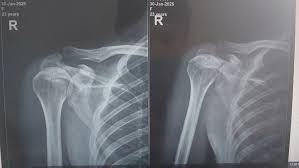 Image result for Shoulder XRay