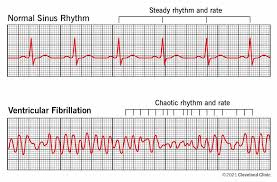 Image result for Ventricular Fibrillation Management in the Adult