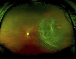 The retina is the part of your eye that captures the image of what you are looking at, similar to film in a camera. Retinal Detachment Pre Op Retina Image Bank