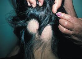 Learn about its symptoms, causes, and treatment. Alopecia Areata Treatment Atlanta Hair Loss Treatment Clinic Nina Ross Atlanta Trichology