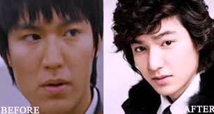 Lee Min Ho Plastic Surgery Before And After Photo Celebrity Plastic Surgery Plastic Surgery Korean Plastic Surgery