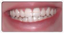 Teeth bands are an affordable way to fix a gap between your teeth. Teeth Gap Bands Close Gapped Teeth