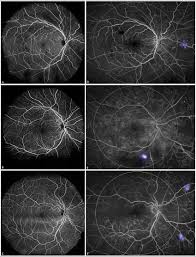 Image result for Acute Vision Loss