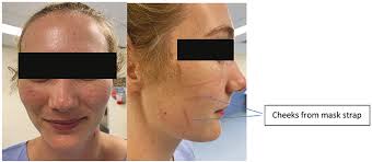 Maintaining skin health and integrity for staff wearing personal protective  equipment for prolonged periods: a practical tip sheet :: Cambridge Media  Journals