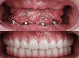An immediate denture is a denture that is made prior to the extraction of the natural teeth, which is inserted into the mouth immediately after the these teeth are extracted after initial implant healing, and often these teeth are in an ideal implant site for the final restoration. Immediate Dentures Delhi India Cost Of Same Day Dentures Delhi India