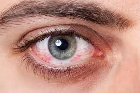 Bloodshot eyes describe a condition in which the whites of the eyes appear red. Red Eye Mydr Com Au