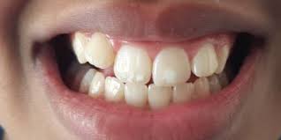 Case Study Biominf Fixes White Spots White Marks White Lesions On Teeth