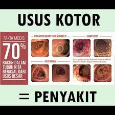 4 tanda usus anda kotor, dan bagaimana cara membersihkannya. Tanda Usus Kotor Yang Menjadi Punca Kebanyakan Penyakit Diet Psoriasis Bau Badan