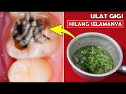 Maybe you would like to learn more about one of these? Hanya 5 Menit Sakit Gigi Sembuh Total Cara Mengeluarkan Ulat Gigi Secara Alami Jihan Alia Youtube Kesehatan Gigi Pemutih Gigi Alami Obat Alami