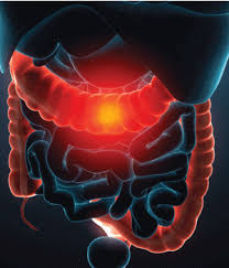 What are the symptoms of colorectal cancer? What S New In Treating Ulcerative Colitis And Diverticulitis Today S Hospitalist