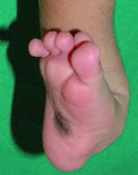 Abnormal feet or legs, such as clubfoot. Klumpfuss Und Andere Fussdefekte Gesundheitsprobleme Von Kindern Msd Manual Ausgabe Fur Patienten