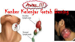 Image result for kanker