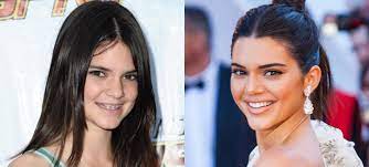 But celebrities aren't all born with these perfect teeth. 6 Celebrities With Braces Before And After Wonderful Transformations