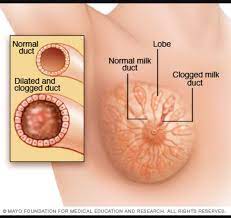 Jan 25, 2021 · symptoms of clogged milk ducts 1) small lump that's sore and painful but becomes less painful after nursing. Pumping Log Clogged Ducts La Lactation Llc