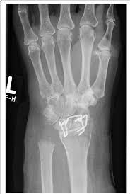 Image result for Wrist XRay
