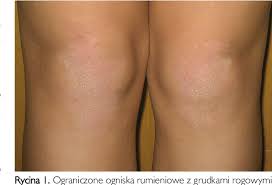 Drugs used to treat pityriasis rubra pilaris. Figure 3 From Pityriasis Rubra Pilaris Juvenile Type Iv Case Report Semantic Scholar