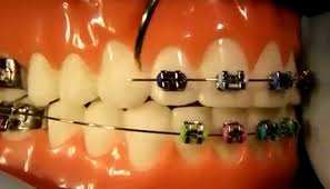You've waited a long time and finally the time has arrived. Fixing Broken Braces Metal Ceramic And Invisalign Trays