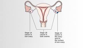 Ovarian cancer is malignant, or cancerous, cells that affect tissues in the ovaries. Ovarian Cancer Pictures Symptoms And Diagnosis
