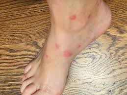 Mix these well and prepare the solution. Home Remedies For Fire Ant Bites That Really Work Convos With Karen