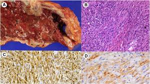 In making a diagnosis of mesothelioma, it is important to confirm the location of. The Differential Diagnosis Between Pleural Sarcomatoid Mesothelioma And Spindle Cell Pleomorphic Sarcomatoid Carcinomas Of The Lung Evidence Based Guidelines From The International Mesothelioma Panel And The Mesopath National Reference Center