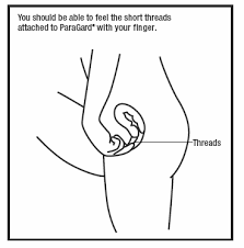 The most common side effect of the copper iud is heavier and longer periods — especially the first 3 to 6 months after insertion, says gaither. Https Www Accessdata Fda Gov Drugsatfda Docs Label 2005 018680s060lbl Pdf