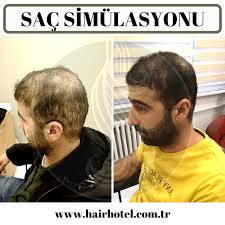 Sac Simulasyonu Sac Kadin Doktorlar