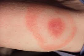 I Want To Talk About Lyme Disease My Stem Cell Transplant Experience Beautylymin