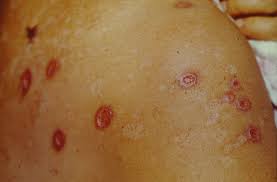 We did not find results for: Neurotic Excoriations Skin Picking Disorder Dermatology Advisor