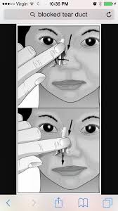 What to do if your baby's tear ducts are blocked? Pin On Holistic